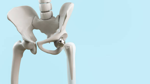 Hip arthroplasty debate.